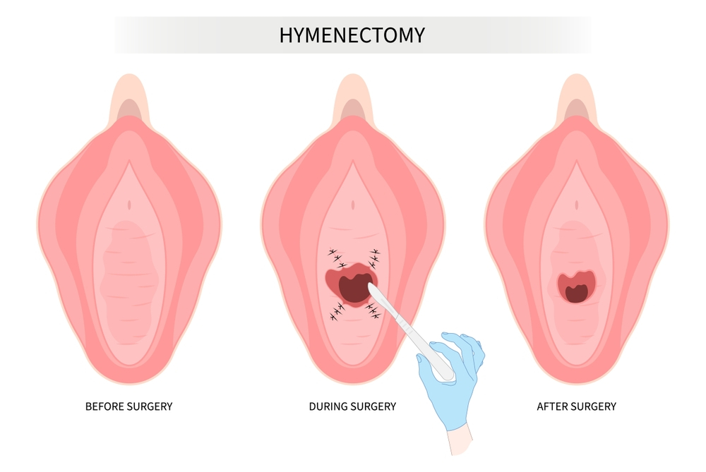 HYMENOPLASTY