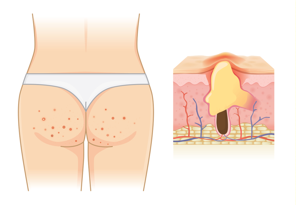 Pilonidal Sinus