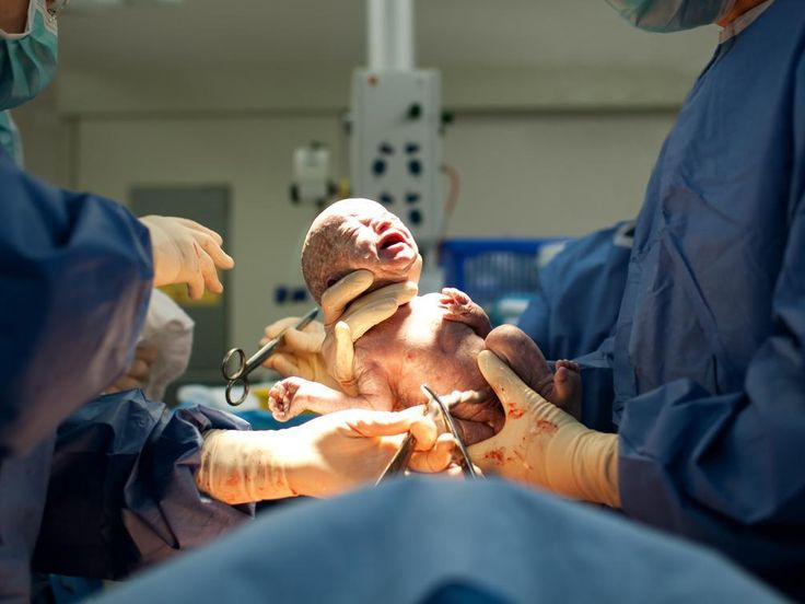 Caesarean Delivery