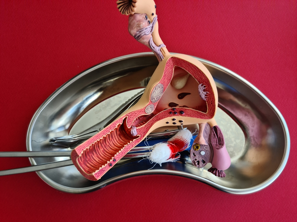 Total Laparoscopic Hysterectomy