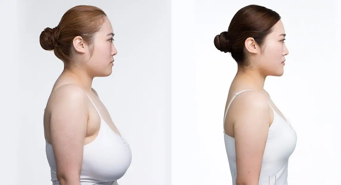 Breast Reduction