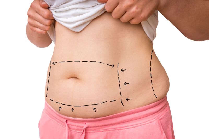 Tummy Tuck