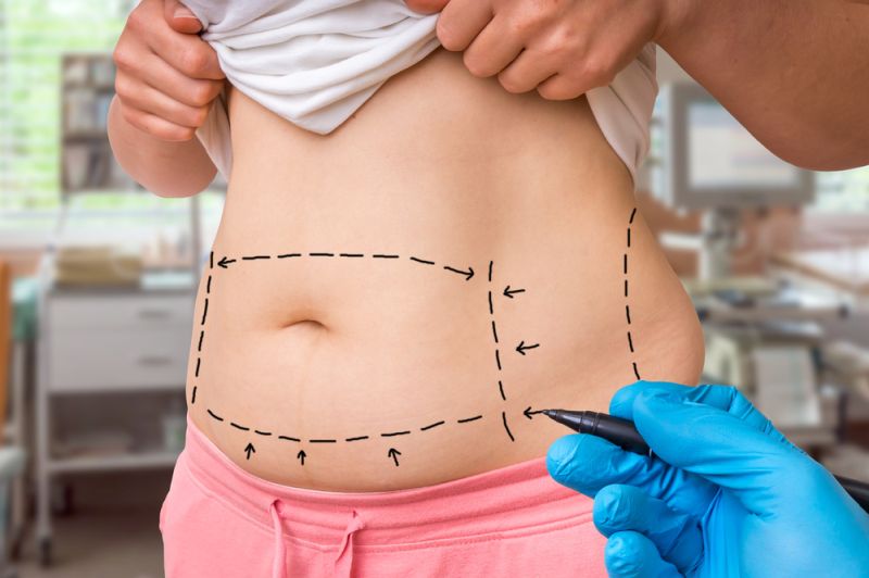 Abdominal Wall Reconstruction