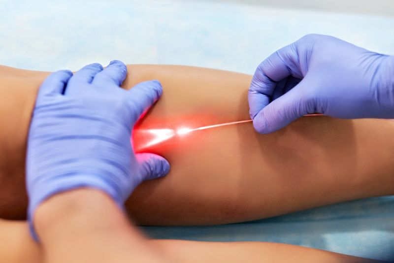 Laser Varicose Vein