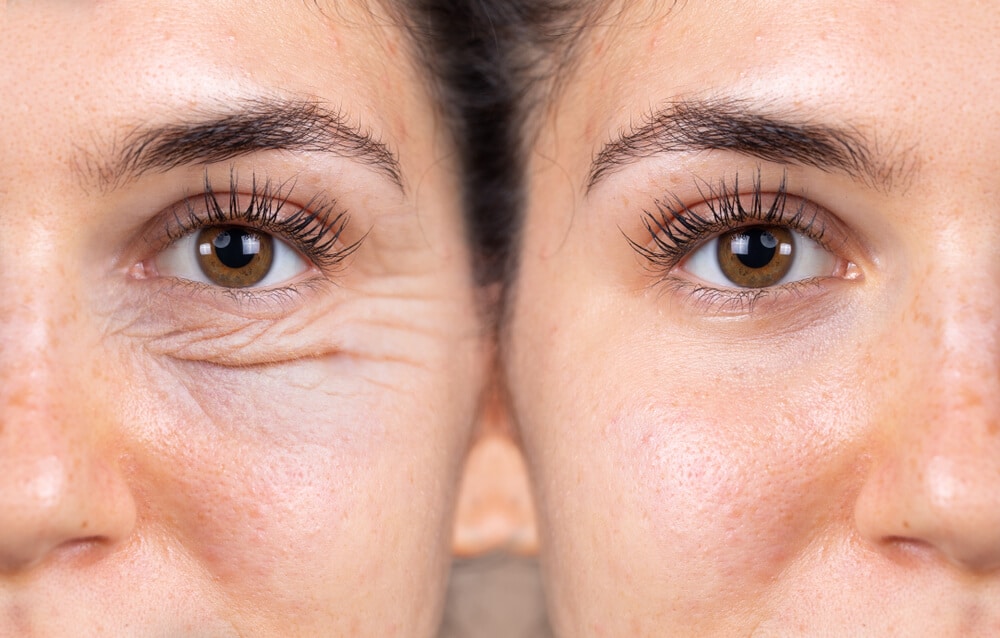 Blepharoplasty