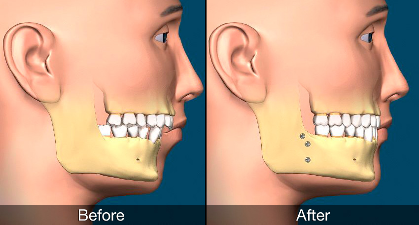 Chin Correction Or Genioplasty