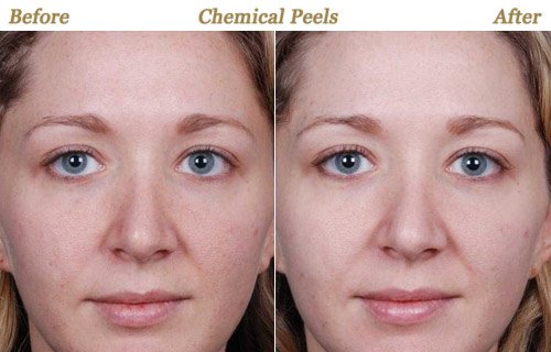 Dermabrasion Chemical Peeling