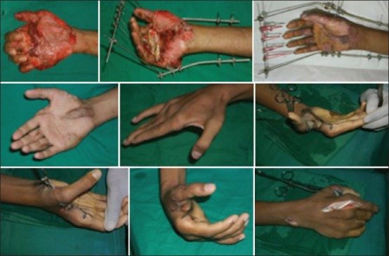 Crush Injuries Of The Hand