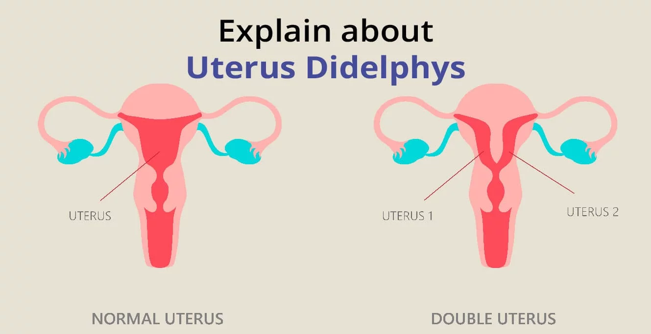 Double Uterus