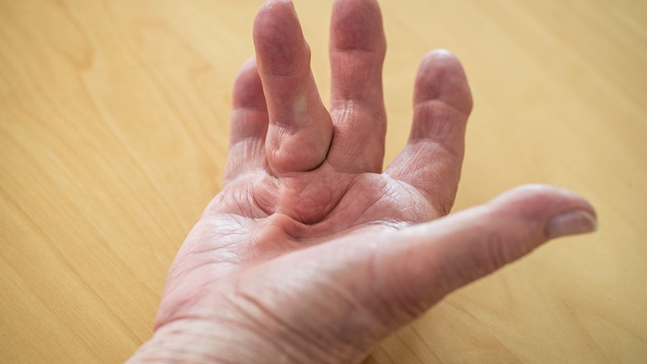 Dupuytrens contracture