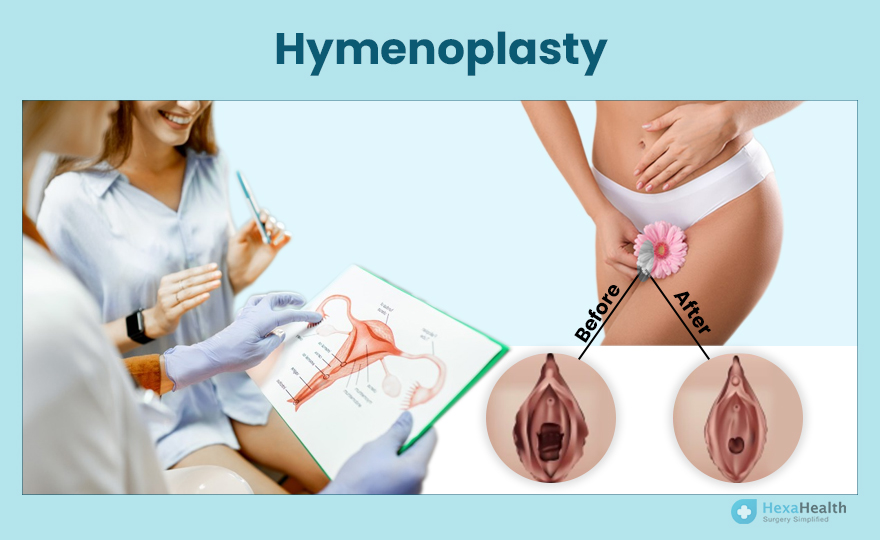 Hymenoplasty