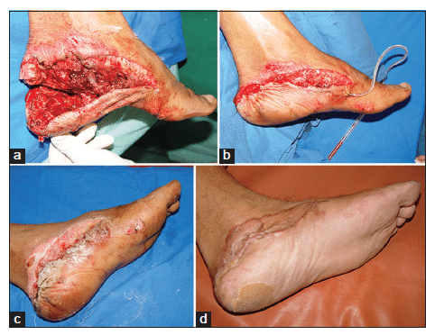 Heel Pad Avulsions