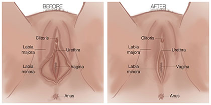 Labiaplasty