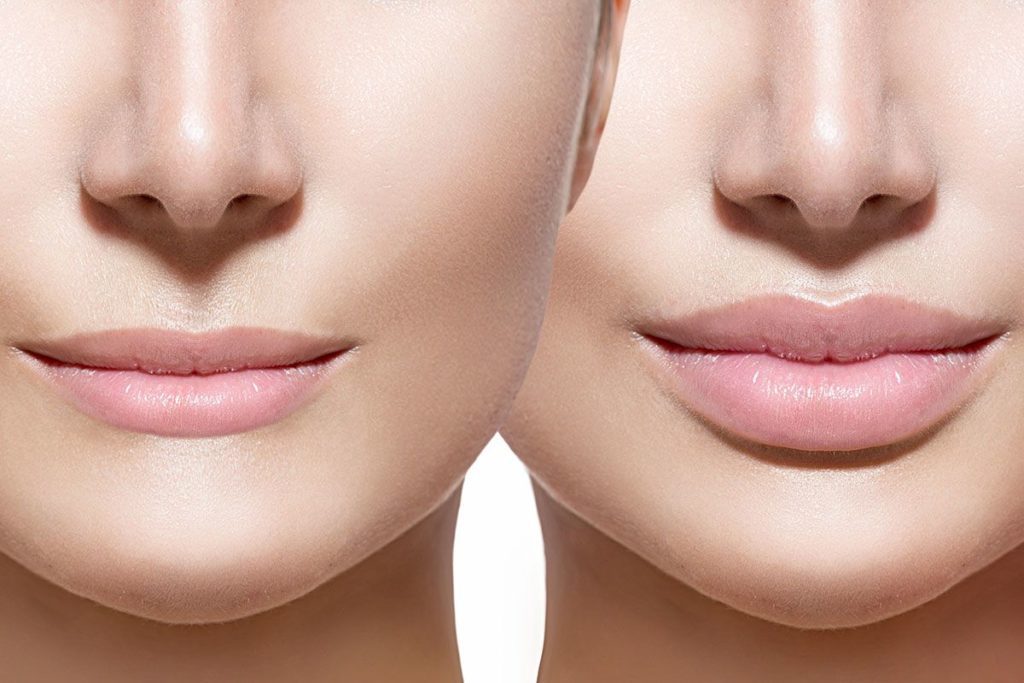 Lip Lift, Augmentation, Reduction