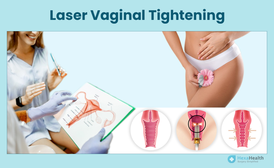 Laser Vaginal Rejuvenation