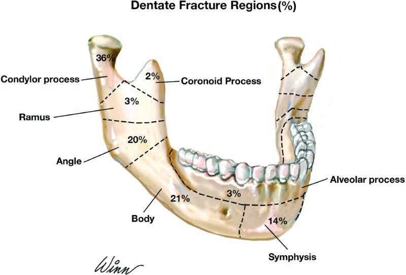 Mandible Fracture