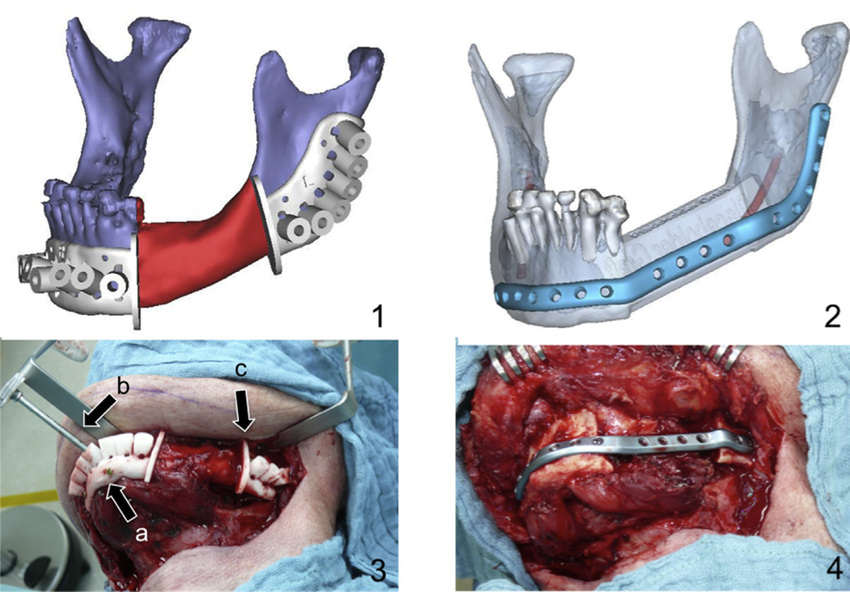 Mandible Reconstruction