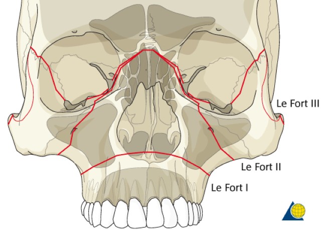 Maxillary Fracture