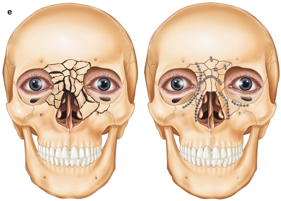 Naso Ethmoidal Fractures