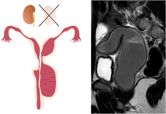 Ohvira Syndrome