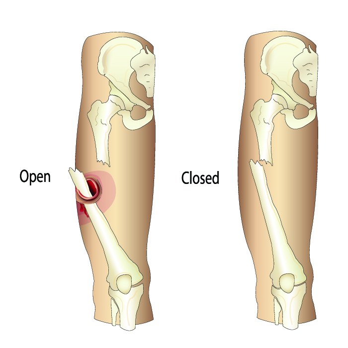 Open Fractures