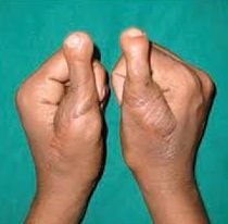 Toe to thumb transplantation