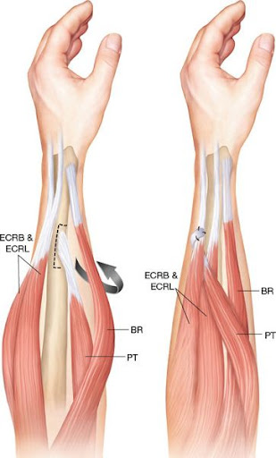 Tendon Repairs And Tendon Transfers