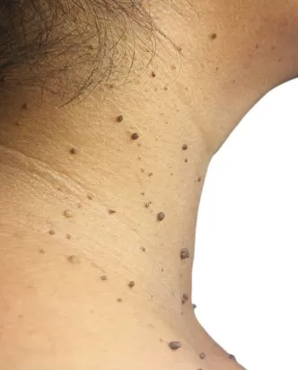 Scar, Moles, Wart removal and correction