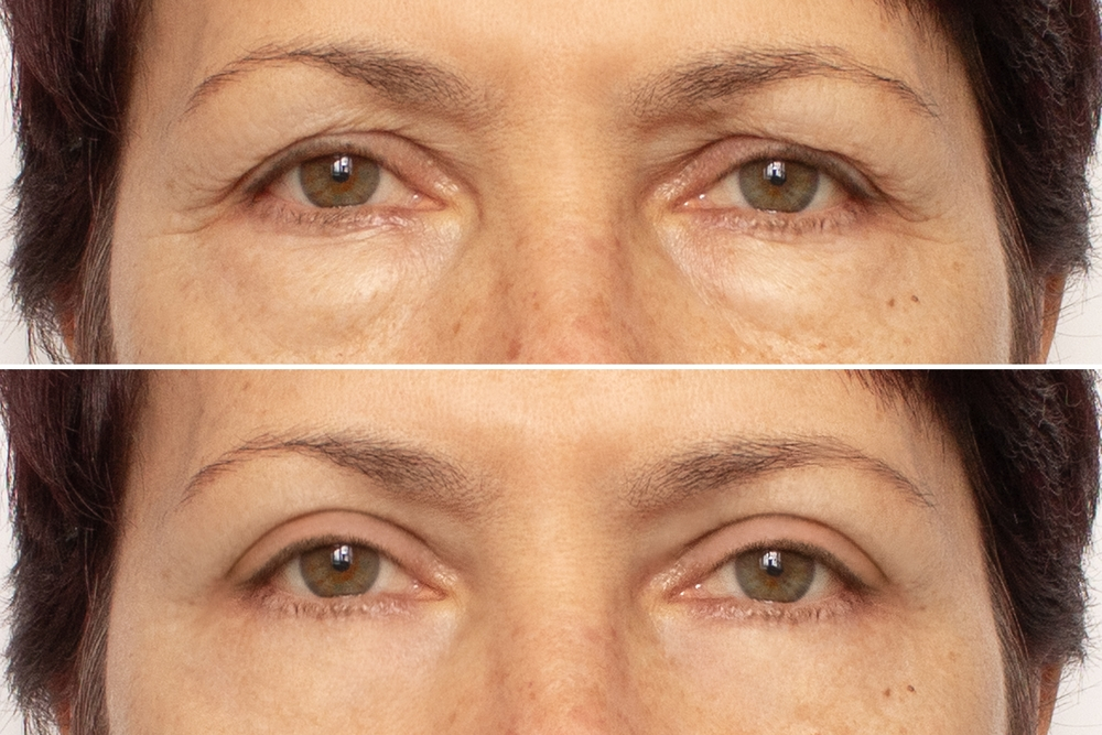 Ptosis Correction