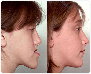 Protuding Lower Jaw Correction