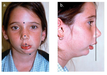 TMJ Ankylosis Correction