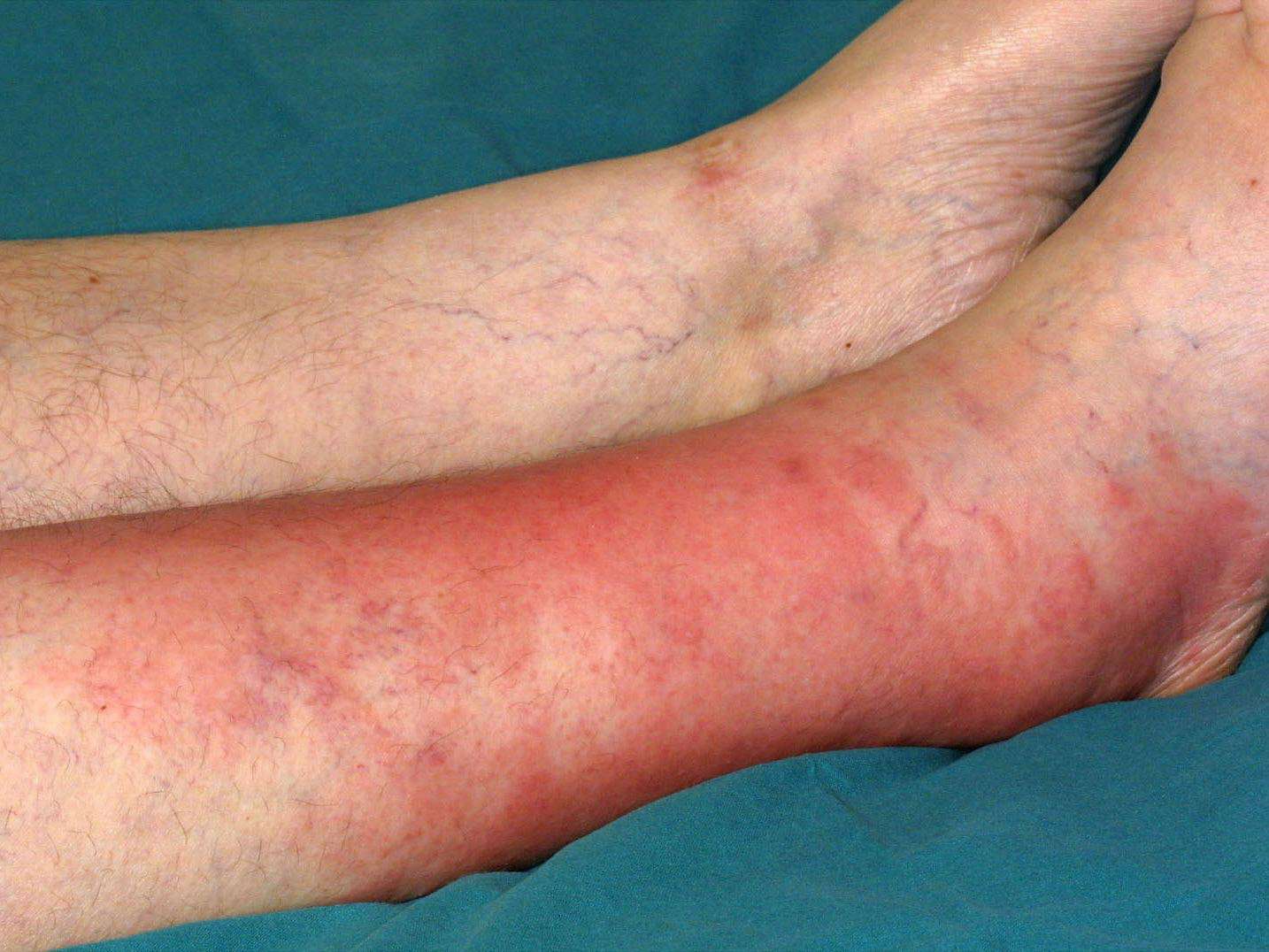 Cellulitis